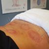 Sports Recovery Acupuncture: 6 Key Benefits You Should Know